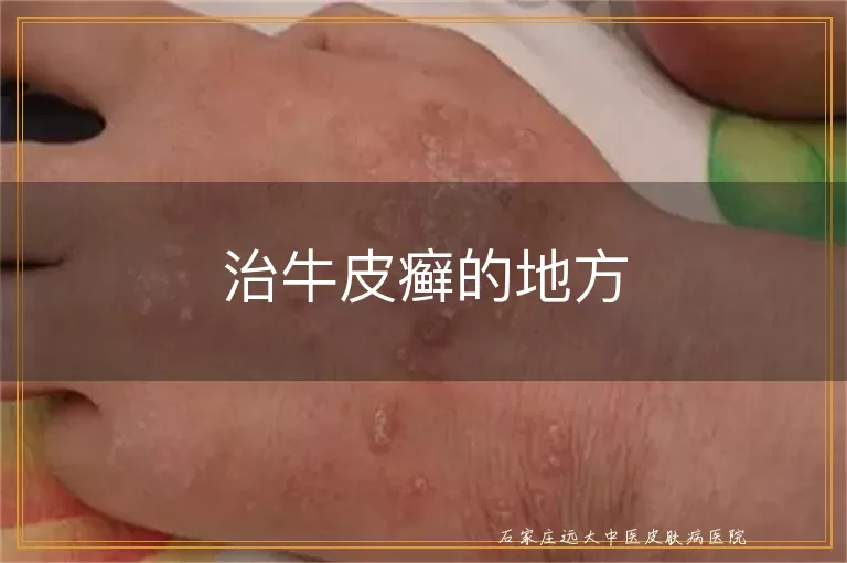 治牛皮癣的地方
