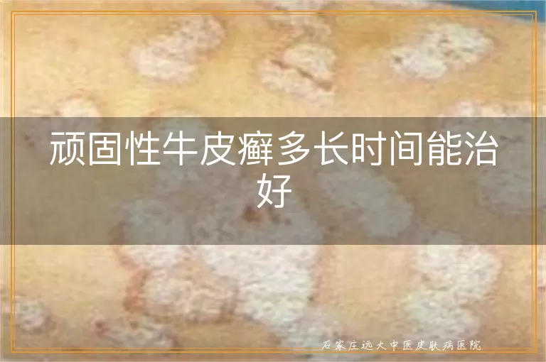 顽固性牛皮癣多长时间能治好