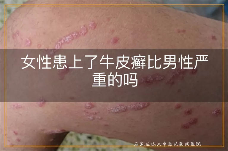 女性患上了牛皮癣比男性严重的吗