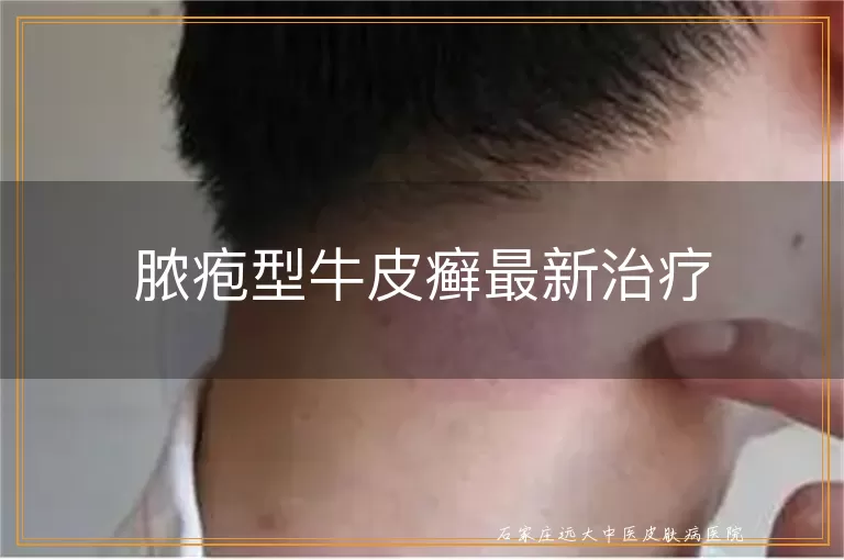 脓疱型牛皮癣最新治疗