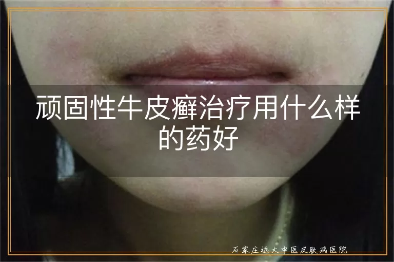 顽固性牛皮癣治疗用什么样的药好