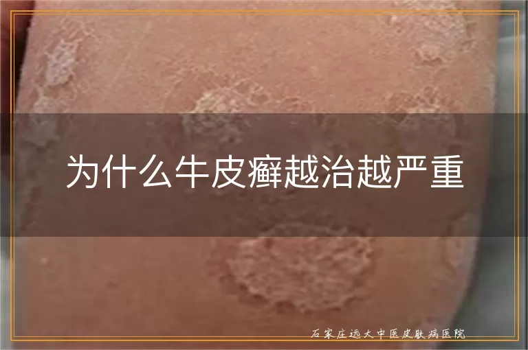 为什么牛皮癣越治越严重