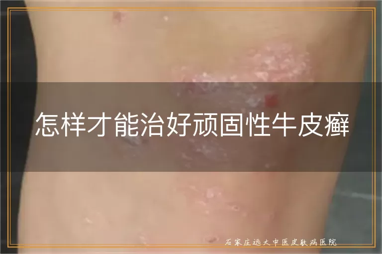 怎样才能治好顽固性牛皮癣