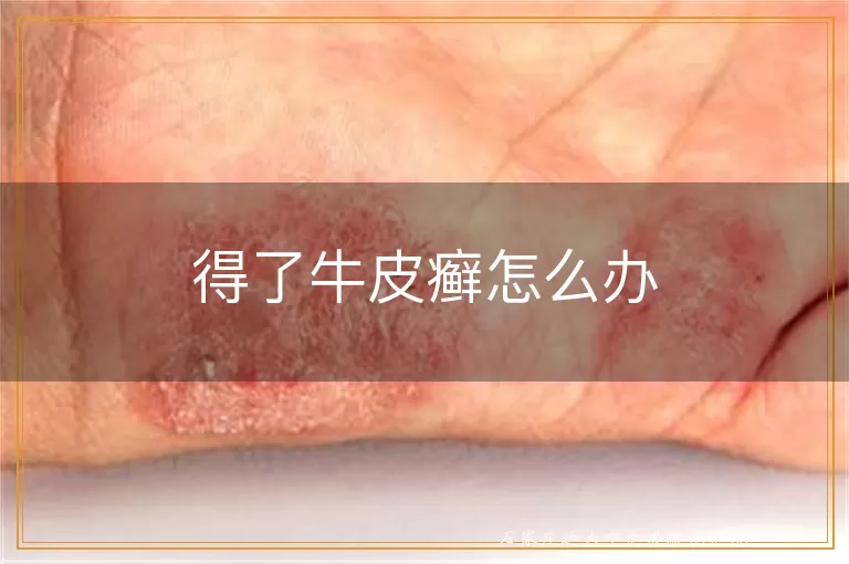 得了牛皮癣怎么办
