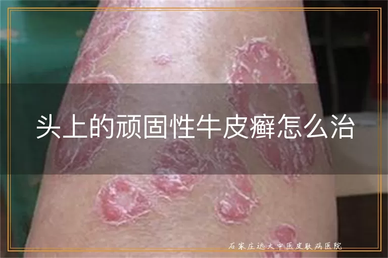 头上的顽固性牛皮癣怎么治