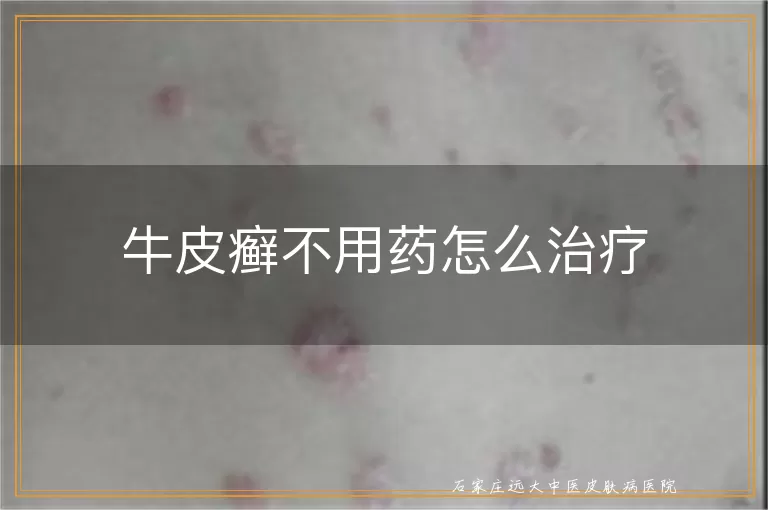 牛皮癣不用药怎么治疗