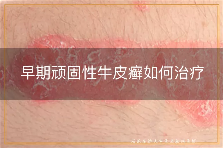 早期顽固性牛皮癣如何治疗