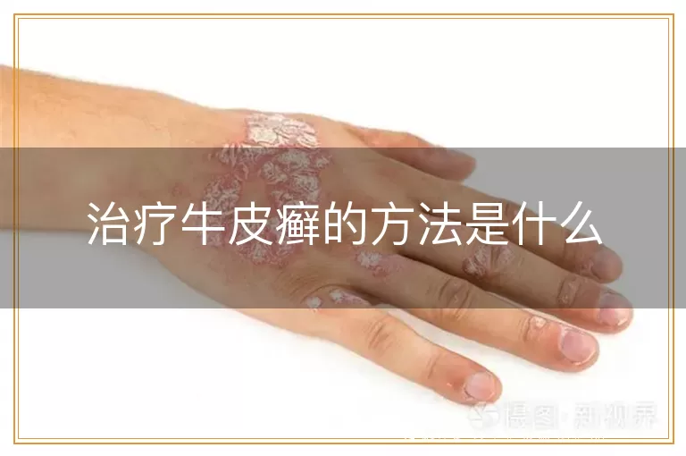 治疗牛皮癣的方法是什么