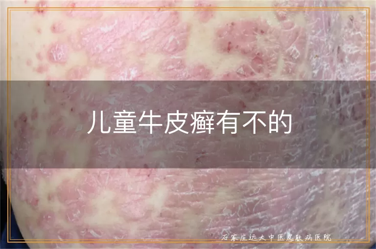 儿童牛皮癣有不的