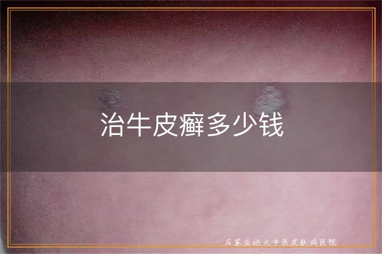 治牛皮癣多少钱