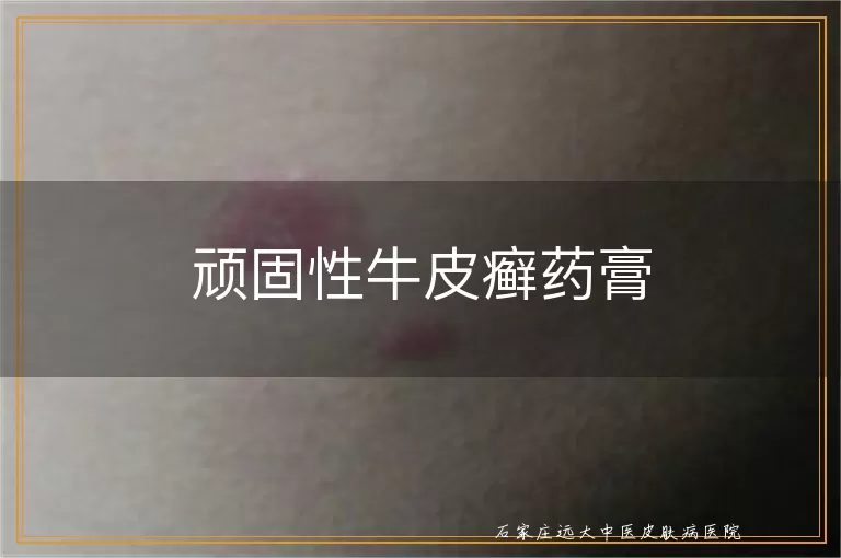 顽固性牛皮癣药膏