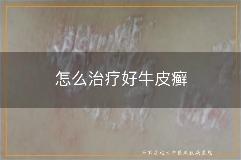 怎么治疗好牛皮癣