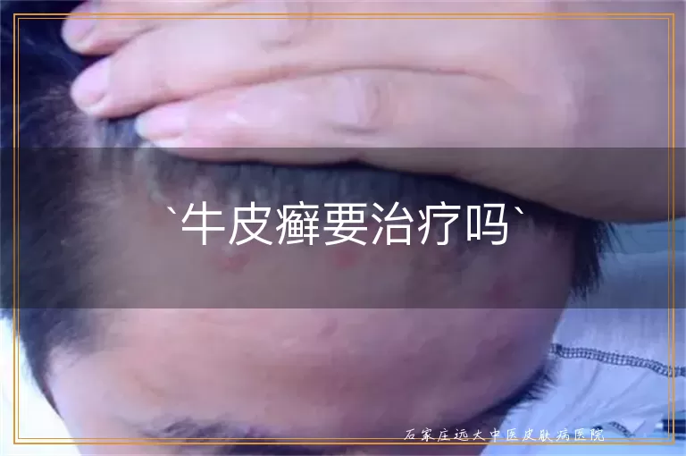 牛皮癣要治疗吗