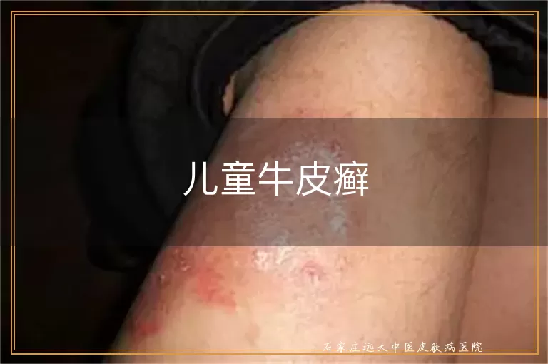 儿童牛皮癣