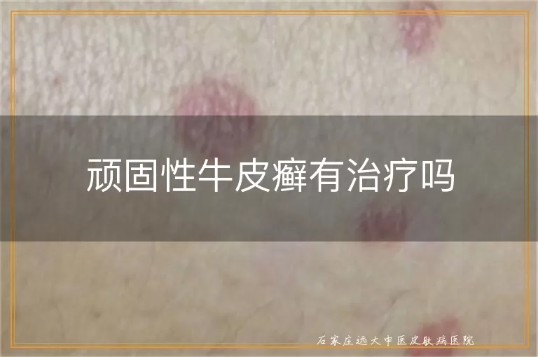 顽固性牛皮癣有治疗吗