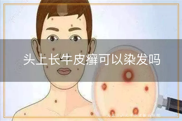 头上长牛皮癣可以染发吗