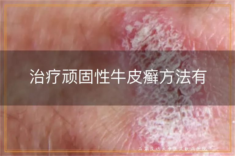 治疗顽固性牛皮癣方法有