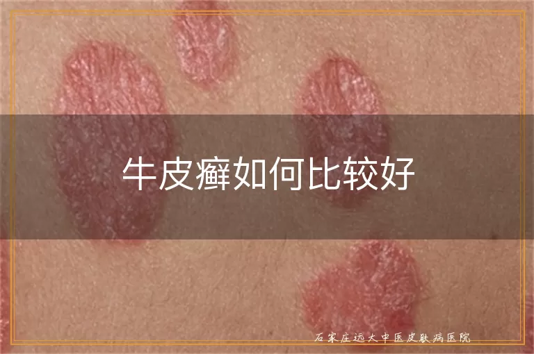 牛皮癣如何比较好