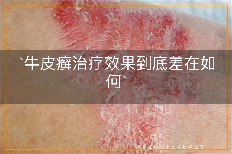 牛皮癣治疗效果到底差在如何