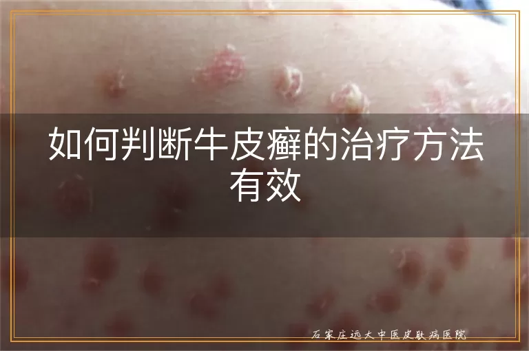 如何判断牛皮癣的治疗方法有效
