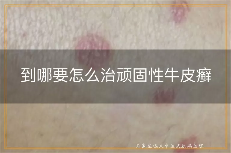 到哪要怎么治顽固性牛皮癣