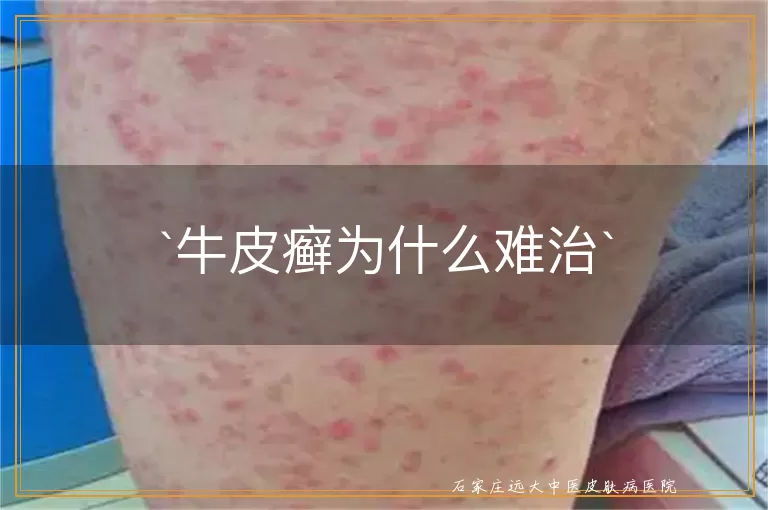牛皮癣为什么难治