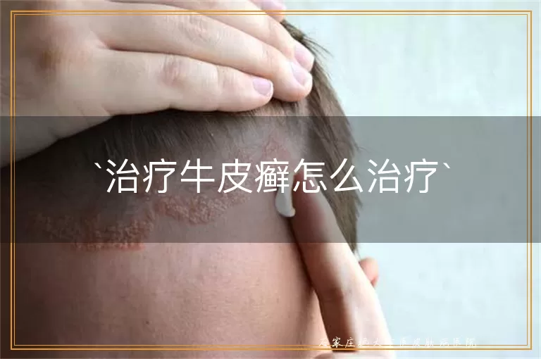 治疗牛皮癣怎么治疗