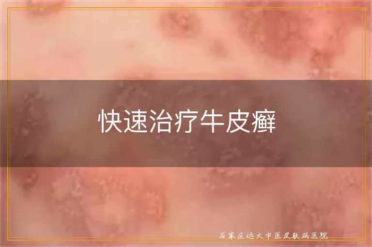 快速治疗牛皮癣