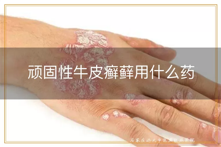 顽固性牛皮癣藓用什么药