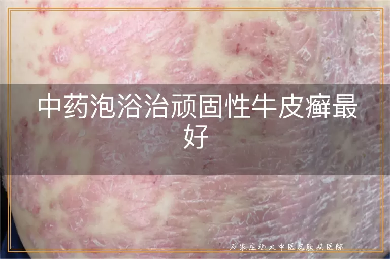 中药泡浴治顽固性牛皮癣最好