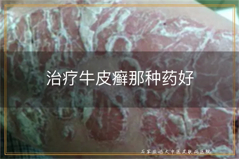 治疗牛皮癣那种药好
