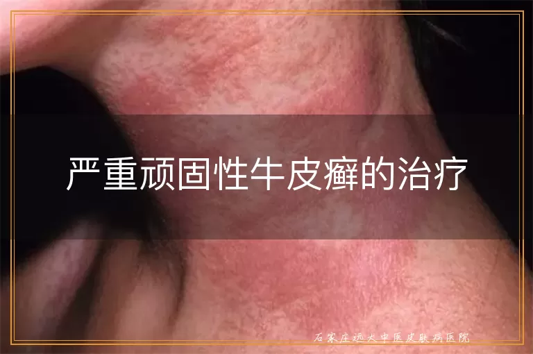 严重顽固性牛皮癣的治疗