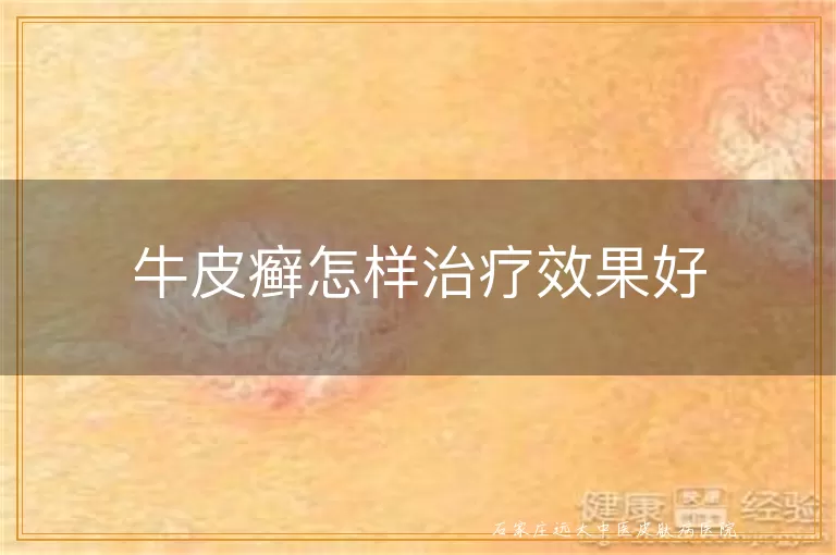 牛皮癣怎样治疗效果好