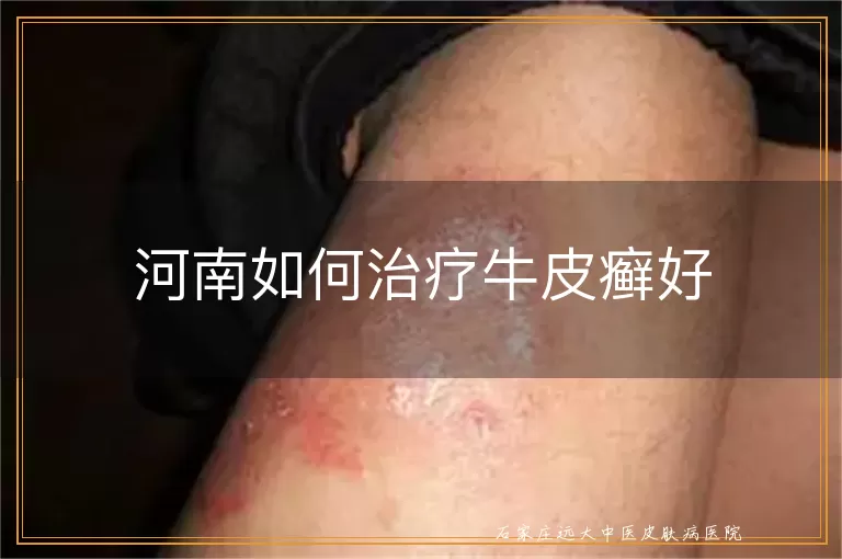 河南如何治疗牛皮癣好