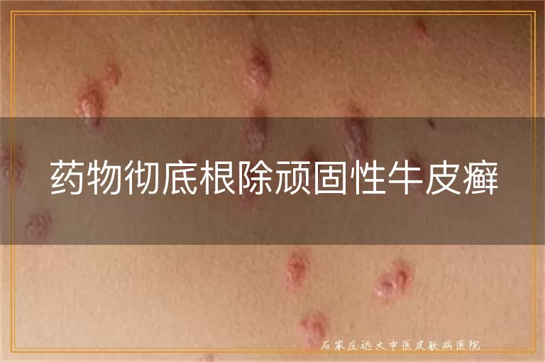 药物彻底根除顽固性牛皮癣