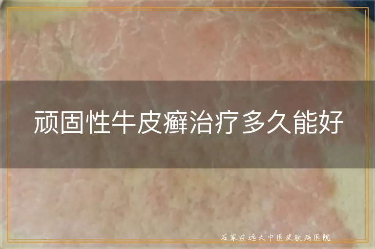 顽固性牛皮癣治疗多久能好