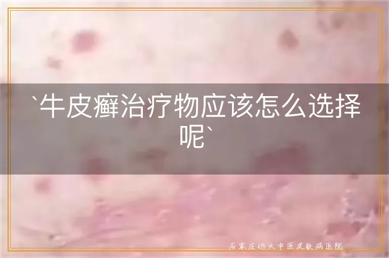 牛皮癣治疗物应该怎么选择呢