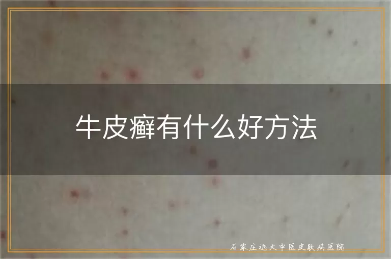 牛皮癣有什么好方法