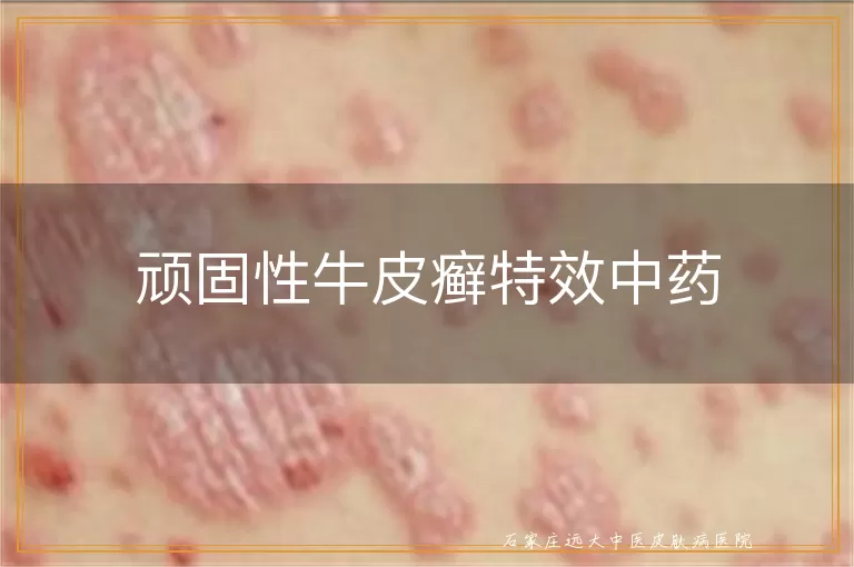 顽固性牛皮癣特效中药