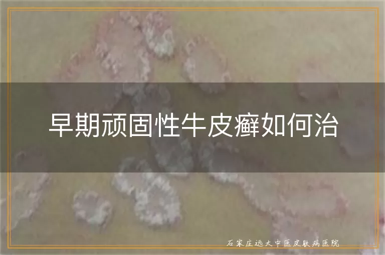 早期顽固性牛皮癣如何治