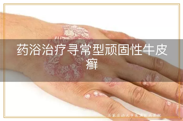 药浴治疗寻常型顽固性牛皮癣