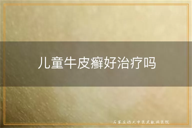 儿童牛皮癣好治疗吗