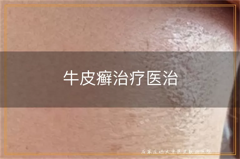 牛皮癣治疗医治