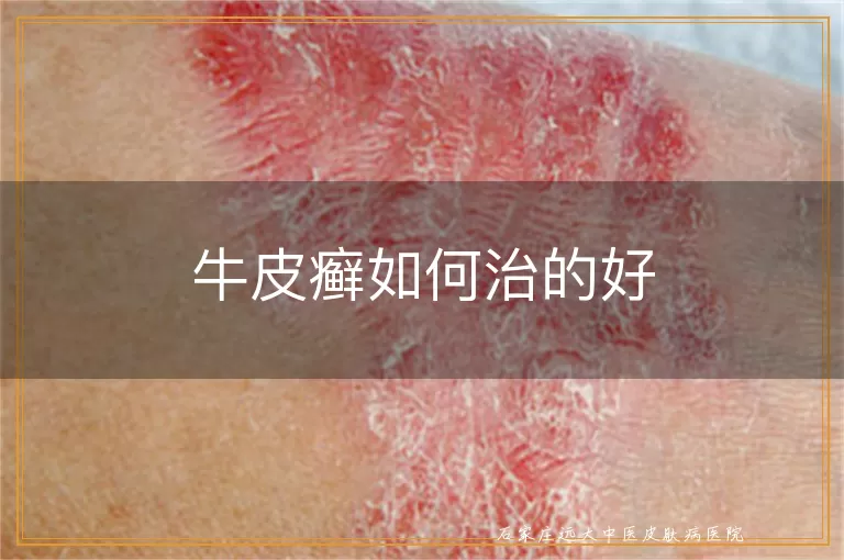 牛皮癣如何治的好