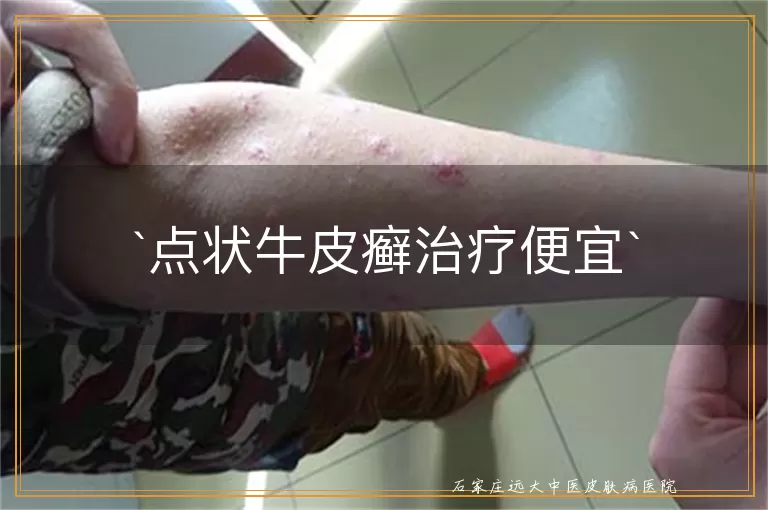 点状牛皮癣治疗便宜