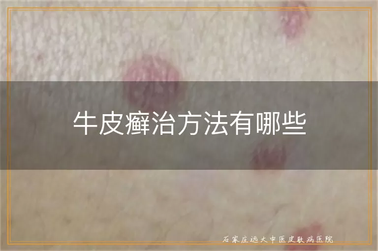 牛皮癣治方法有哪些