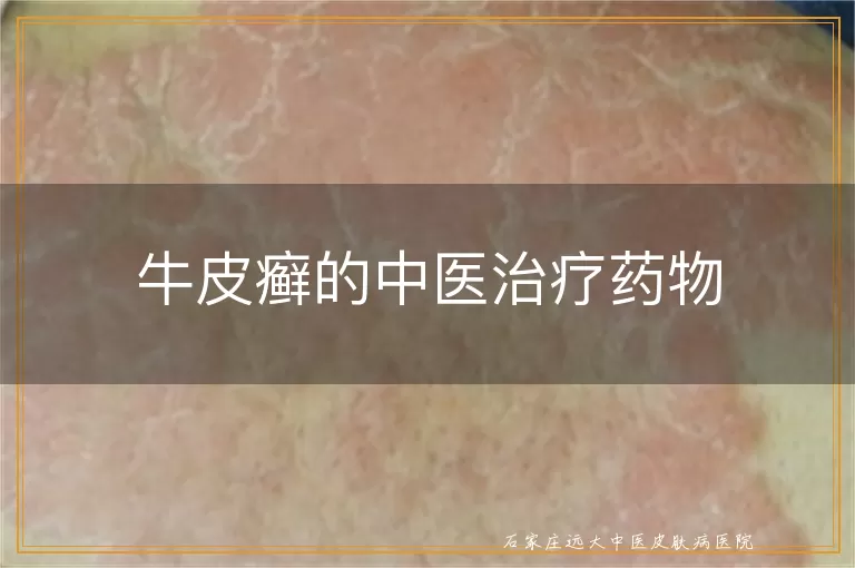 牛皮癣的中医治疗药物