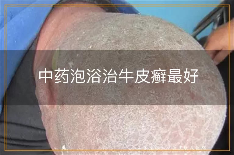 中药泡浴治牛皮癣最好