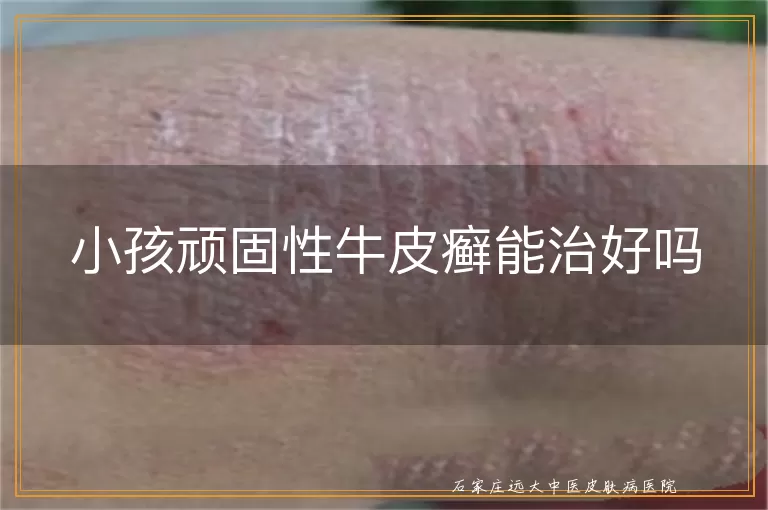 小孩顽固性牛皮癣能治好吗