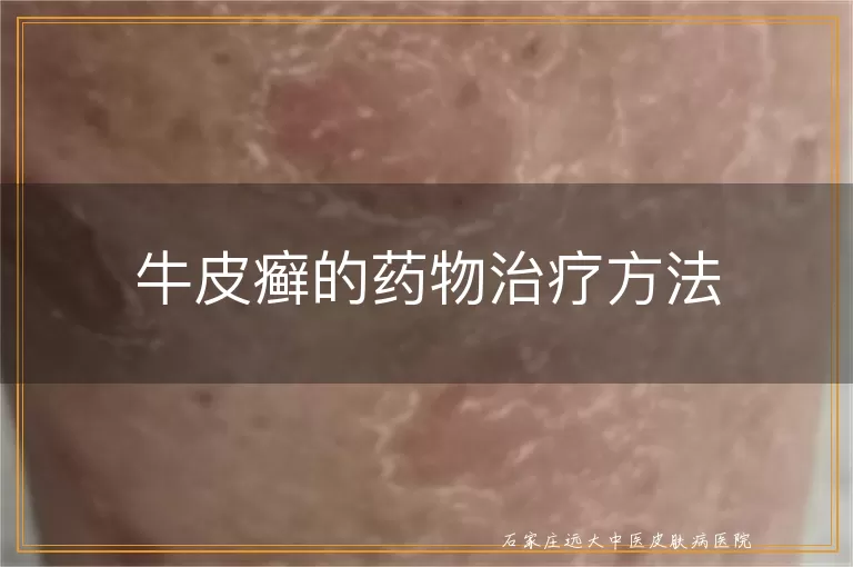 牛皮癣的药物治疗方法